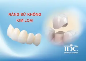 Có nên làm răng sứ kim loại không?