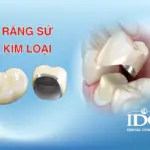 rang su kim loai