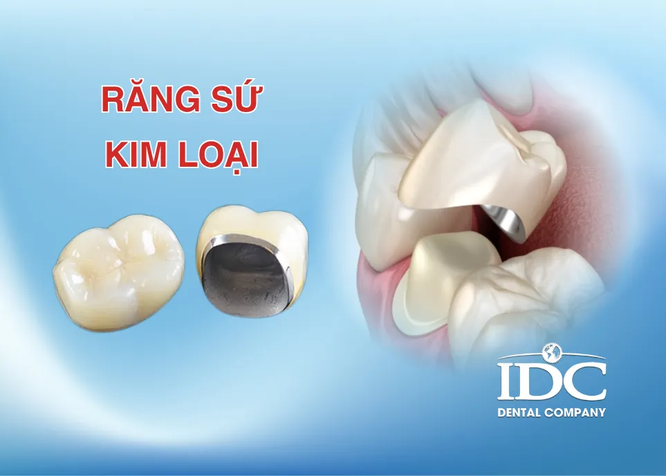 rang su kim loai