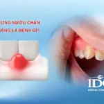 Sưng nướu chân răng là bệnh gì?