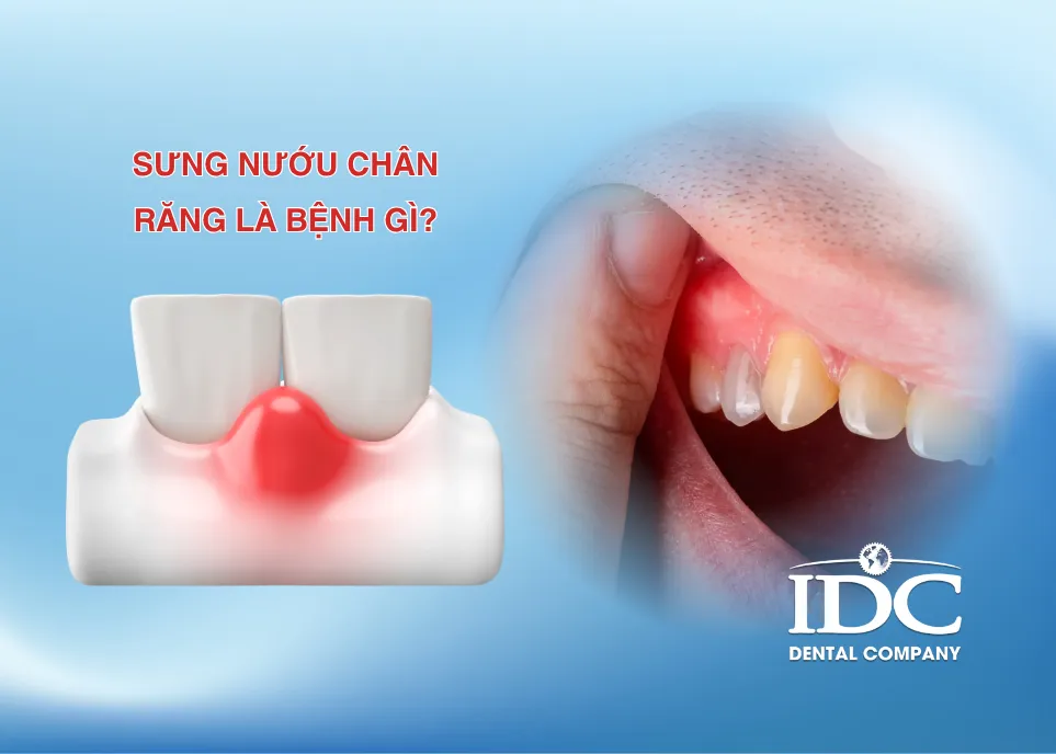 Sưng nướu chân răng là bệnh gì?