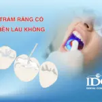 Trám răng có bền lâu không?