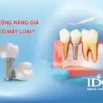Trồng răng giả có mấy loại?