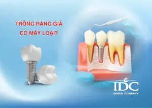 Có nên làm răng sứ kim loại không?