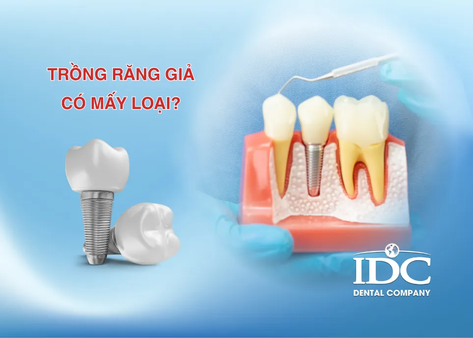 Trồng răng giả có mấy loại?