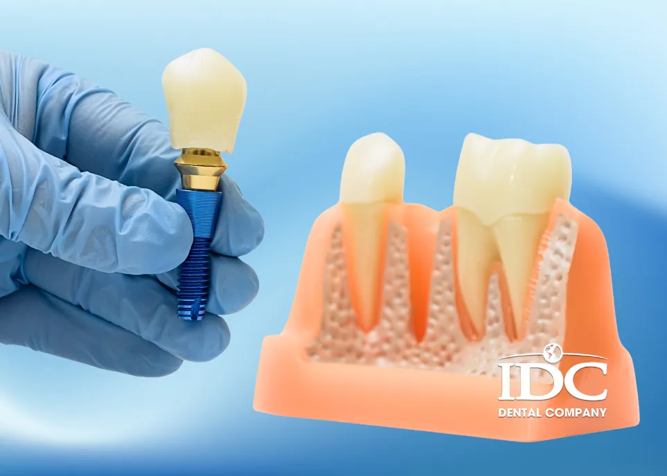 Trồng răng giả bằng cấy Implant