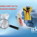 Tủy răng chết có tự khỏi được không?