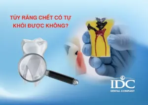 Trám răng có bền lâu không? Bao lâu thì cần thay miếng trám?