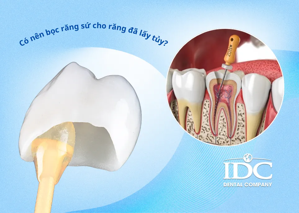 Vì sao nên bọc răng sứ cho răng đã lấy tủy?
