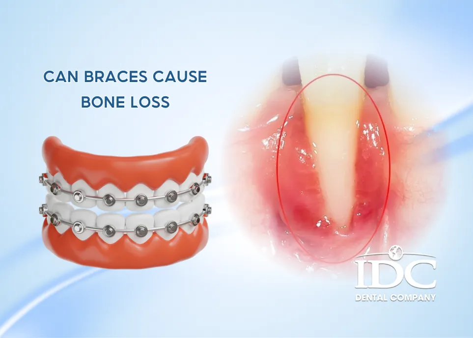Can Braces Cause Bone Loss?
