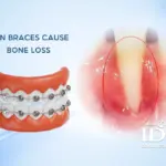 Can Braces Cause Bone Loss