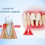Causes of Periodontal Disease