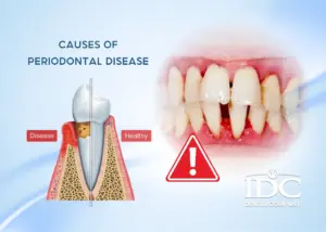 Why should I get teeth cleaning every 6 months?