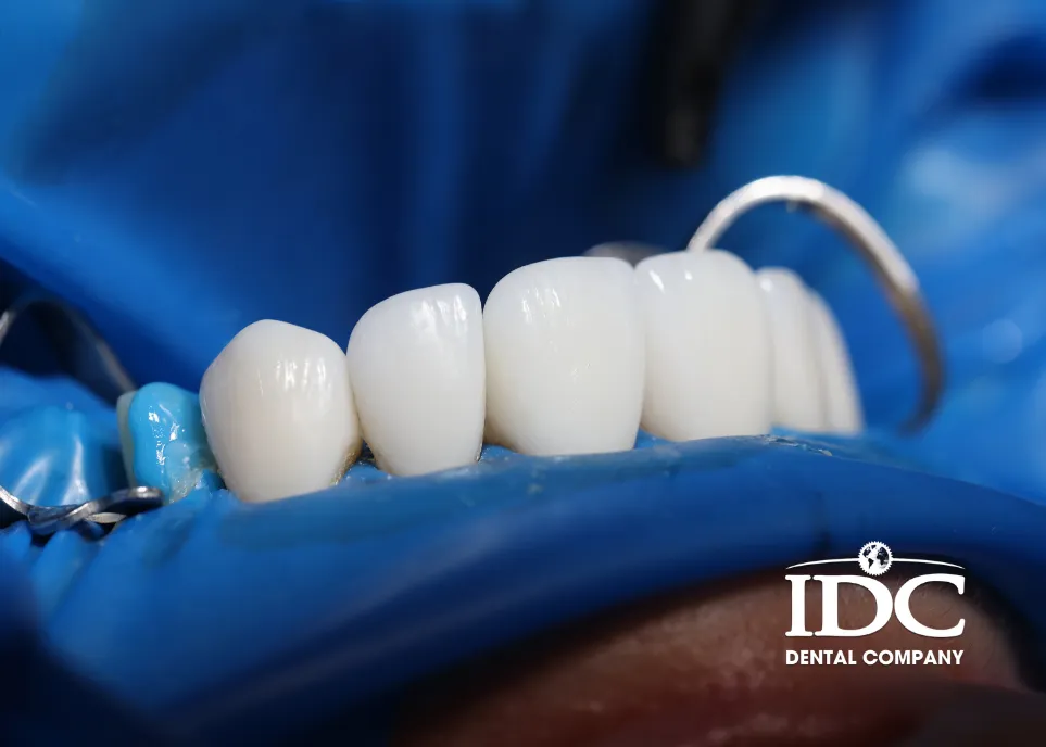 Daily oral care for porcelain crowns