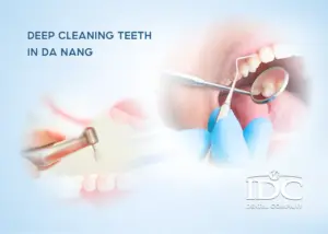 Teeth Whitening