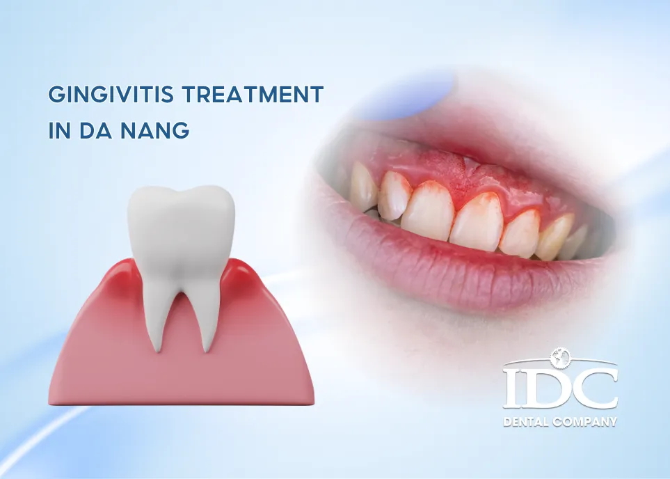 Gingivitis Treatment in Da Nang