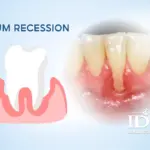 Gum Recession