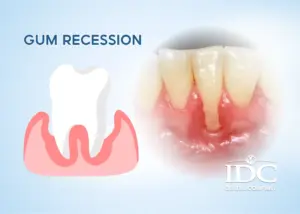 How much does a full-mouth dental implant cost in Da Nang City?