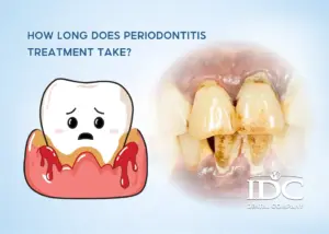 Teeth Whitening
