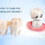 How to care for porcelain crowns to keep them durable and beautiful