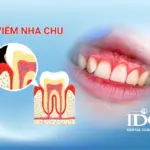 Nguyên nhân bị viêm nha chu là gì?