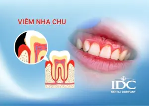 Chỉnh hàm hô không phẫu thuật ở Đà Nẵng: Giải pháp an toàn không đau