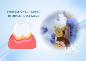 Teeth Whitening