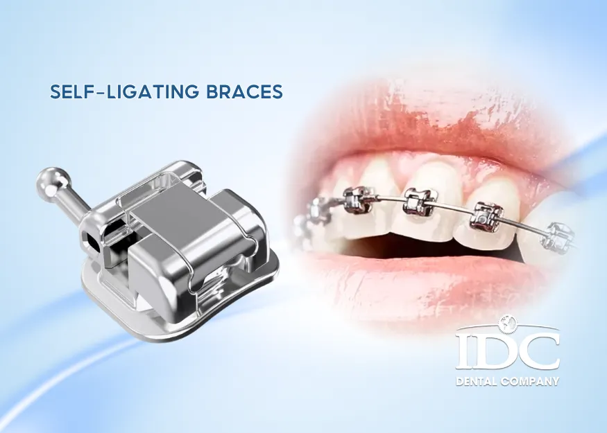 Self-Ligating Braces