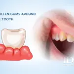 Swollen Gums Around One Tooth