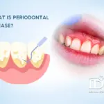 What Is Periodontal Disease?
