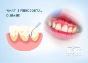 Teeth Whitening