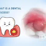 What Is a Dental Abscess