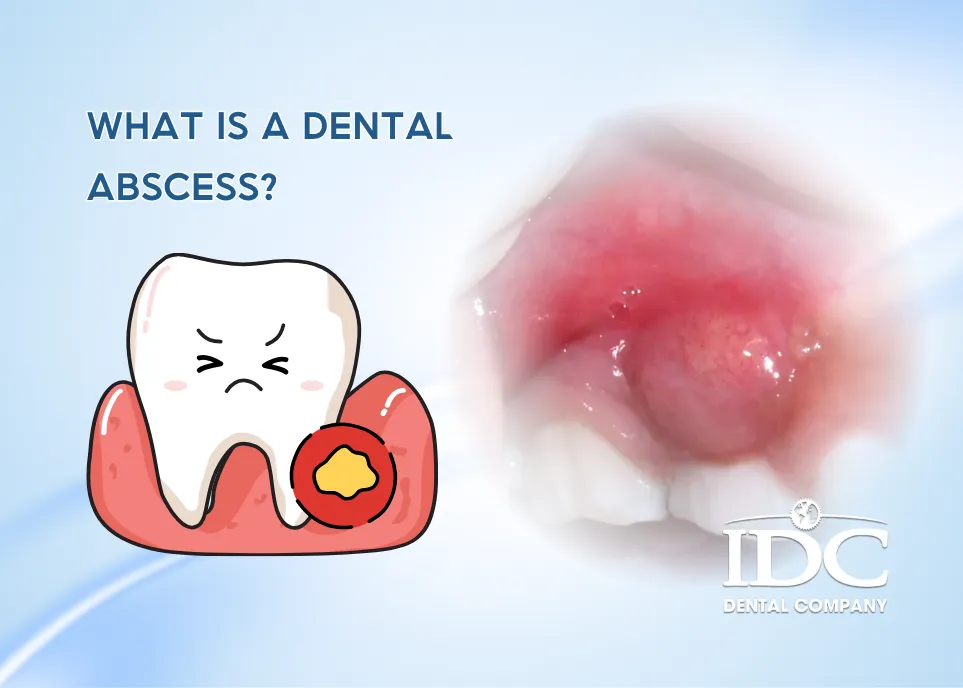 What Is a Dental Abscess?
