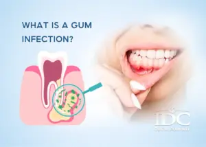 What Happens During a Root Canal Procedure?