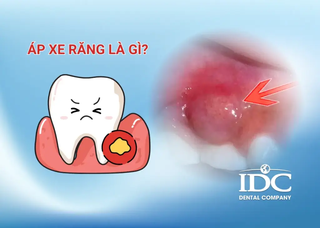 ap xe rang la gi