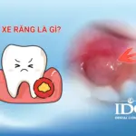 ap xe rang la gi