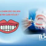 điều trị cười hở lợi