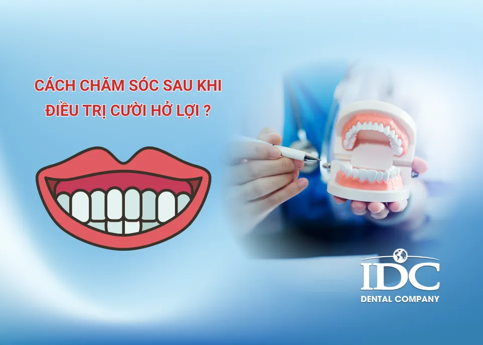 điều trị cười hở lợi