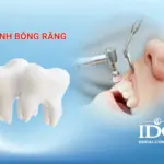 Đánh bóng răng là gì?