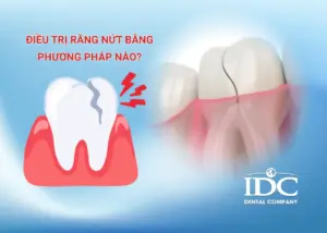 Có nên niềng răng mắc cài sứ không? Ưu nhược điểm và chi phí