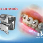 Mắc cài tự buộc là gì?