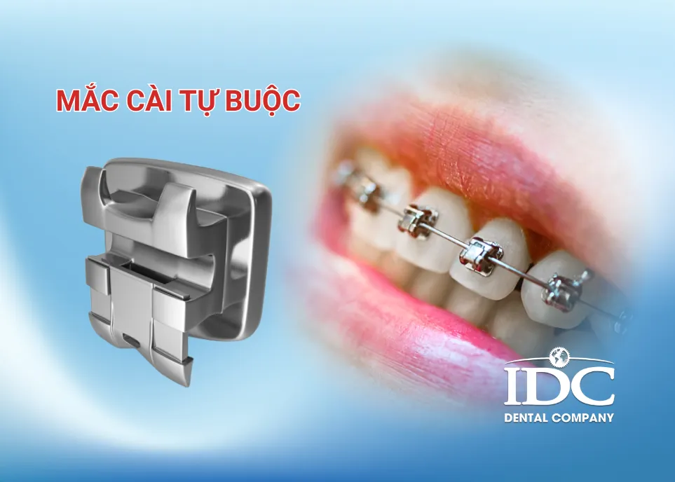 Mắc cài tự buộc là gì?