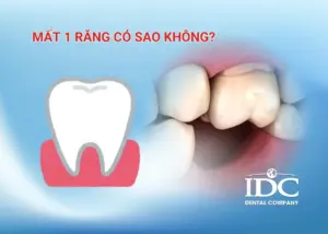 Răng vàng bẩm sinh có làm trắng được không?