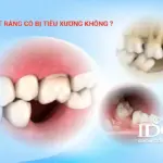 Mất răng có bị tiêu xương hàm không?