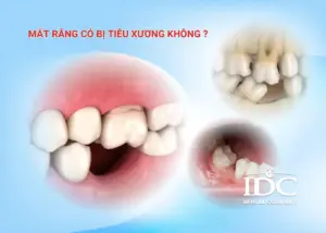 Điều trị răng nứt bằng phương pháp nào?