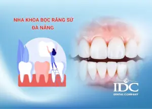 Nha Khoa bọc răng sứ Đà Nẵng