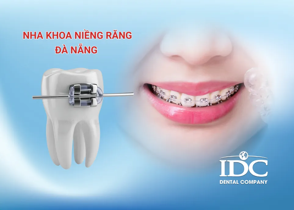 Nha khoa niềng răng Đà Nẵng
