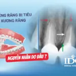 nieng rang bi tieu xuong rang