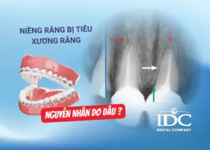 Lấy cao răng có đau không? Sự thật sau khi cạo vôi răng