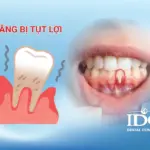 rang bi tut loi la gi